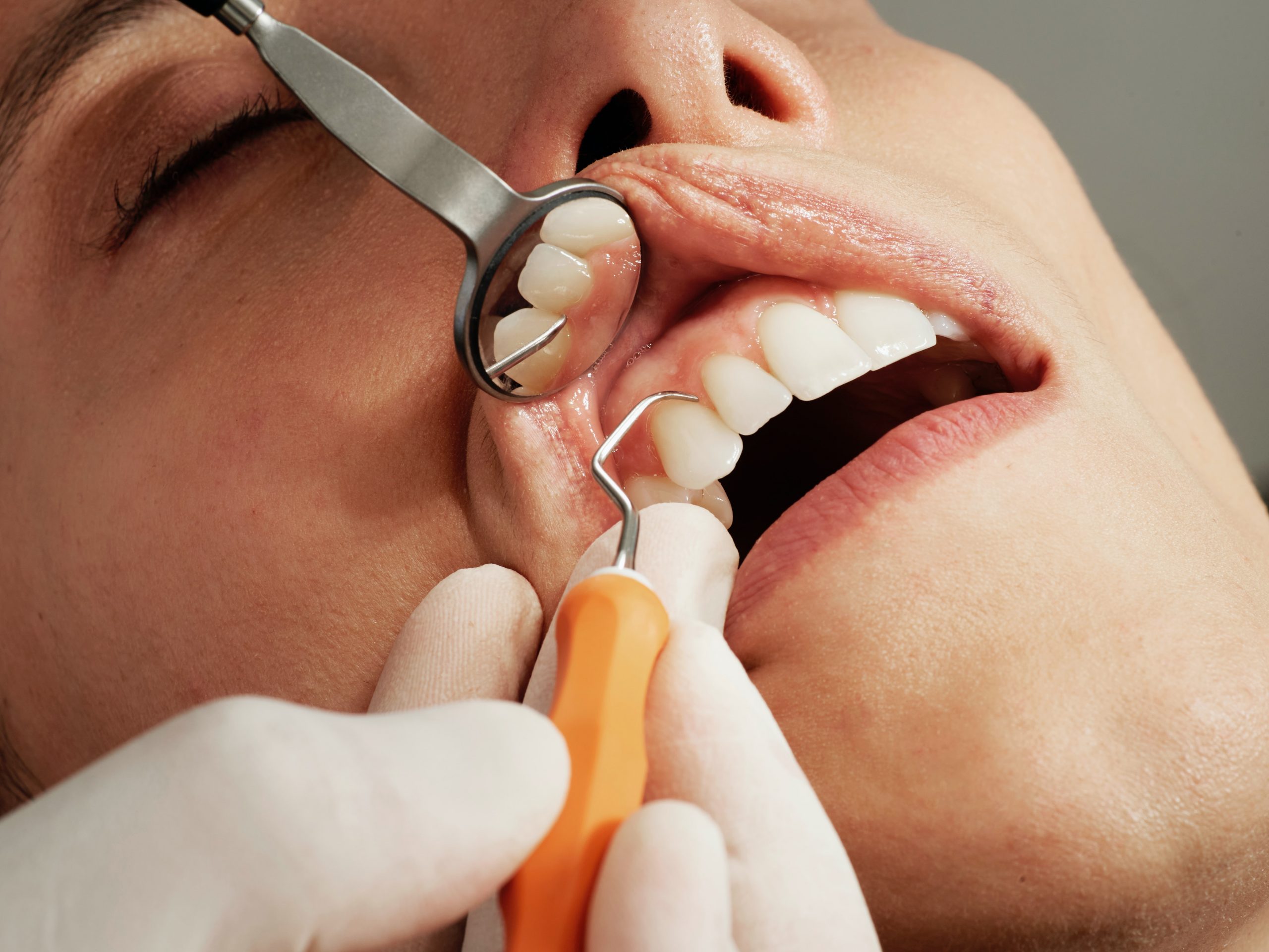 Clareamento de dente vital consultório